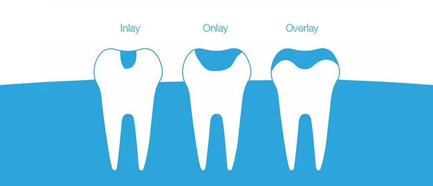 Što su zubne plombe | Štimac Centar dentalne medicine | Što su zubne plombe (zubni ispuni)? | Stomatološka poliklinika Zagreb | Štimac centar dentalne medicine