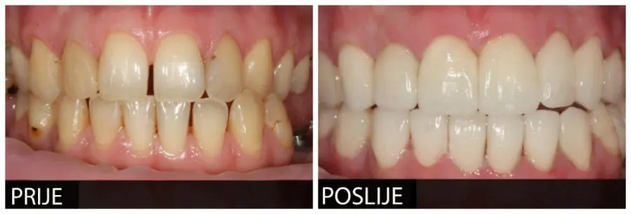 Velika popularnost ljuskica u stomatologiji - Stomatološka poliklinika | Velika popularnost ljuskica u stomatologiji | Stomatološka poliklinika Zagreb | Štimac centar dentalne medicine
