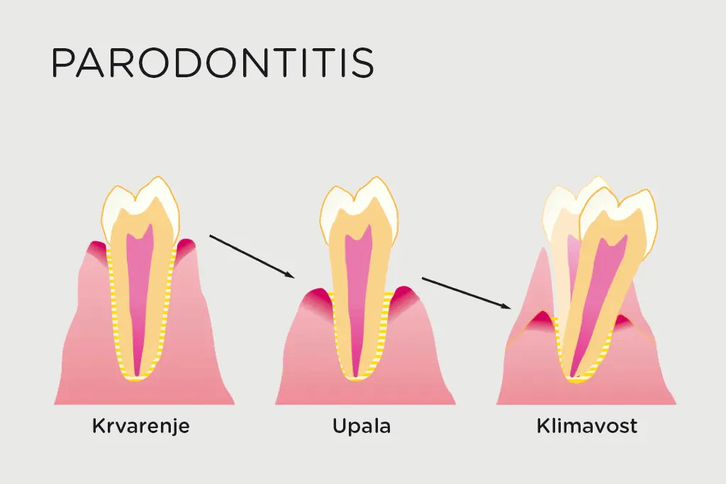 Loš zadah, čudan okus u ustima i krvarenje desni - iza | Loš zadah, čudan okus u ustima i krvarenje desni – iza njih se krije jedna od najčešćih bolesti zubnog mesa | Stomatološka poliklinika Zagreb | Štimac centar dentalne medicine