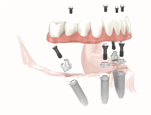 Vaš novi osmijeh uz zubne implantate i opciju All on 4 | drstimac.com | Vaš novi osmijeh uz zubne implantate i opciju „all on 4“ | Stomatološka poliklinika Zagreb | Štimac centar dentalne medicine