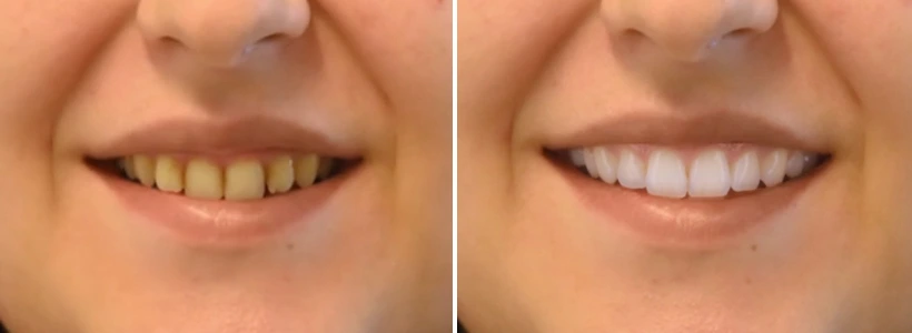Digital Smile Design: kako nastaje savršen osmijeh | Veneers (zubne ljuskice) – što su i kome trebaju?| Stomatološka poliklinika Zagreb | Štimac centar dentalne medicine