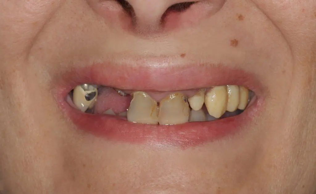 Znate li kako sve možete riješiti problem bezube čeljusti? - | Znate li kako sve možete riješiti problem bezube čeljusti? | Stomatološka poliklinika Zagreb | Štimac centar dentalne medicine