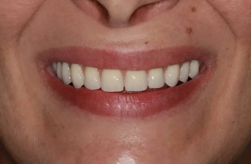 Znate li kako sve možete riješiti problem bezube čeljusti? - | Znate li kako sve možete riješiti problem bezube čeljusti? | Stomatološka poliklinika Zagreb | Štimac centar dentalne medicine