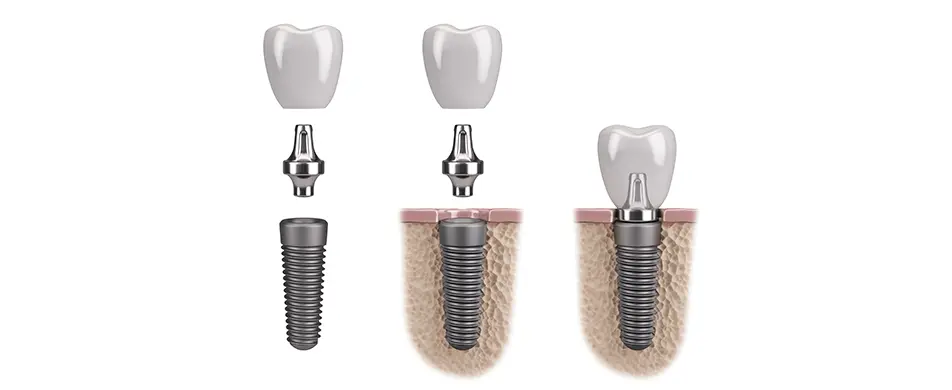 Što su zubni implantati | Štimac Centar dentalne medicine | Što su zubni implantati i što morate znati o njima | Stomatološka poliklinika Zagreb | Štimac centar dentalne medicine