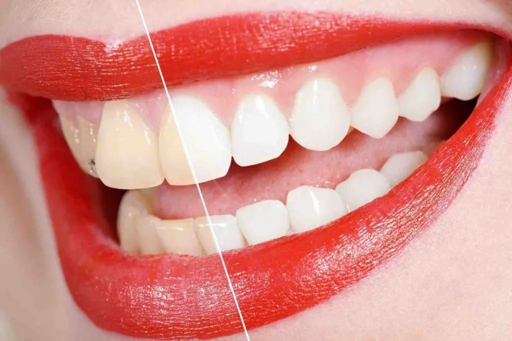 Kućno ili izbjeljivanje kod stomatologa? Prednosti i nedostaci! | Kućno vs. izbjeljivanje kod stomatologa. Prednosti i nedostaci! | Stomatološka poliklinika Zagreb | Štimac centar dentalne medicine