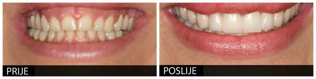 Velika popularnost ljuskica u stomatologiji - Stomatološka poliklinika | Velika popularnost ljuskica u stomatologiji | Stomatološka poliklinika Zagreb | Štimac centar dentalne medicine