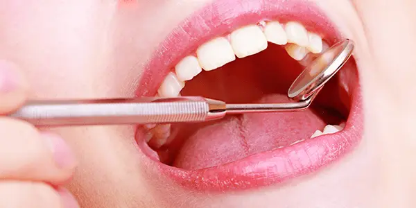 Zašto je karijes najveći neprijatelj vaših zubi? | drstimac.com | Zašto je karijes najveći neprijatelj vaših zubi? | Stomatološka poliklinika Zagreb | Štimac centar dentalne medicine
