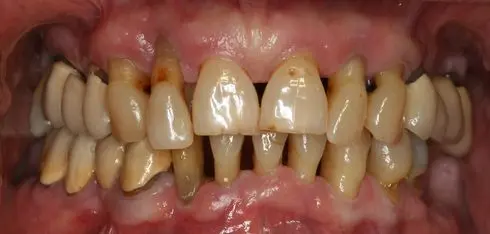 Kako riješiti problem parodontoze? | Stomatološka poliklinika Štimac | Kako riješiti sve češći problem parodontoze? | Stomatološka poliklinika Zagreb | Štimac centar dentalne medicine