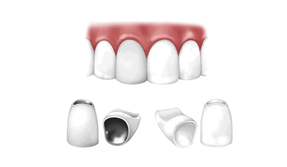 Što su zubne krunice? | Blog | Štimac Centar dentalne medicine | Zašto ugraditi zubne krunice | Stomatološka poliklinika Zagreb | Štimac centar dentalne medicine