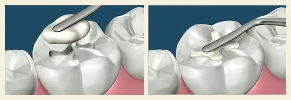 Što su zubne plombe | Štimac Centar dentalne medicine | Što su zubne plombe (zubni ispuni)? | Stomatološka poliklinika Zagreb | Štimac centar dentalne medicine
