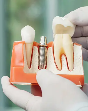 Što sve trebate znati o vađenju zubi? - Što sve trebate znati o vađenju zubi | Štimac centar dentalne medicine