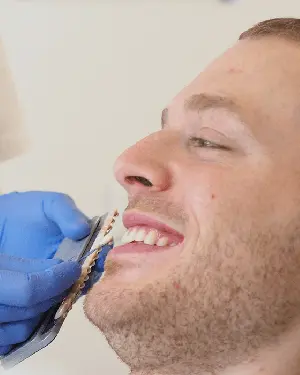 Velika popularnost ljuskica u stomatologiji - Ljuskice za zube | Štimac centar dentalne medicine