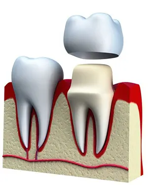 Zašto ugraditi zubne krunice - Zubne krunice | Štimac centar dentalne medicine