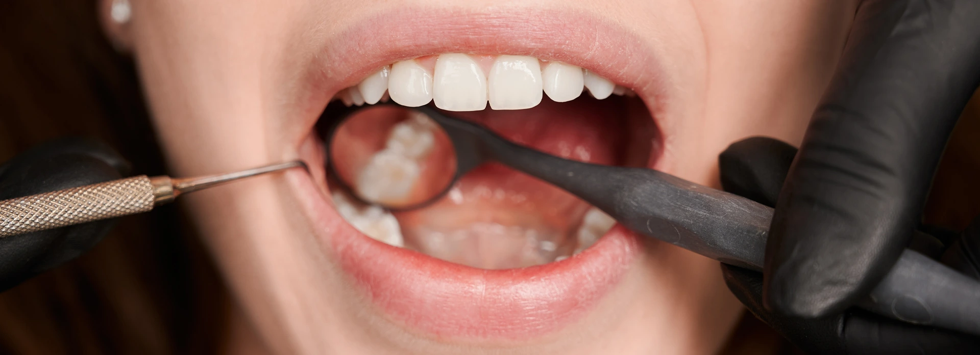 Kako spriječiti karijes? Vodič za zdrave zube u odrasloj dobi - Stomatološka poliklinika Zagreb | Štimac centar dentalne medicine