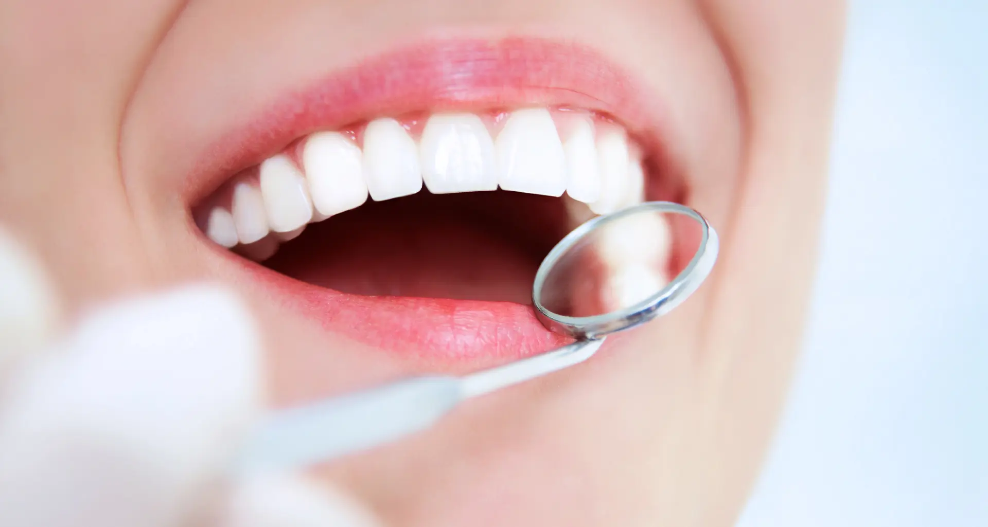 Čišćenje zubnog kamenca - Čišćenje zubnog kamenca | Štimac centar dentalne medicine
