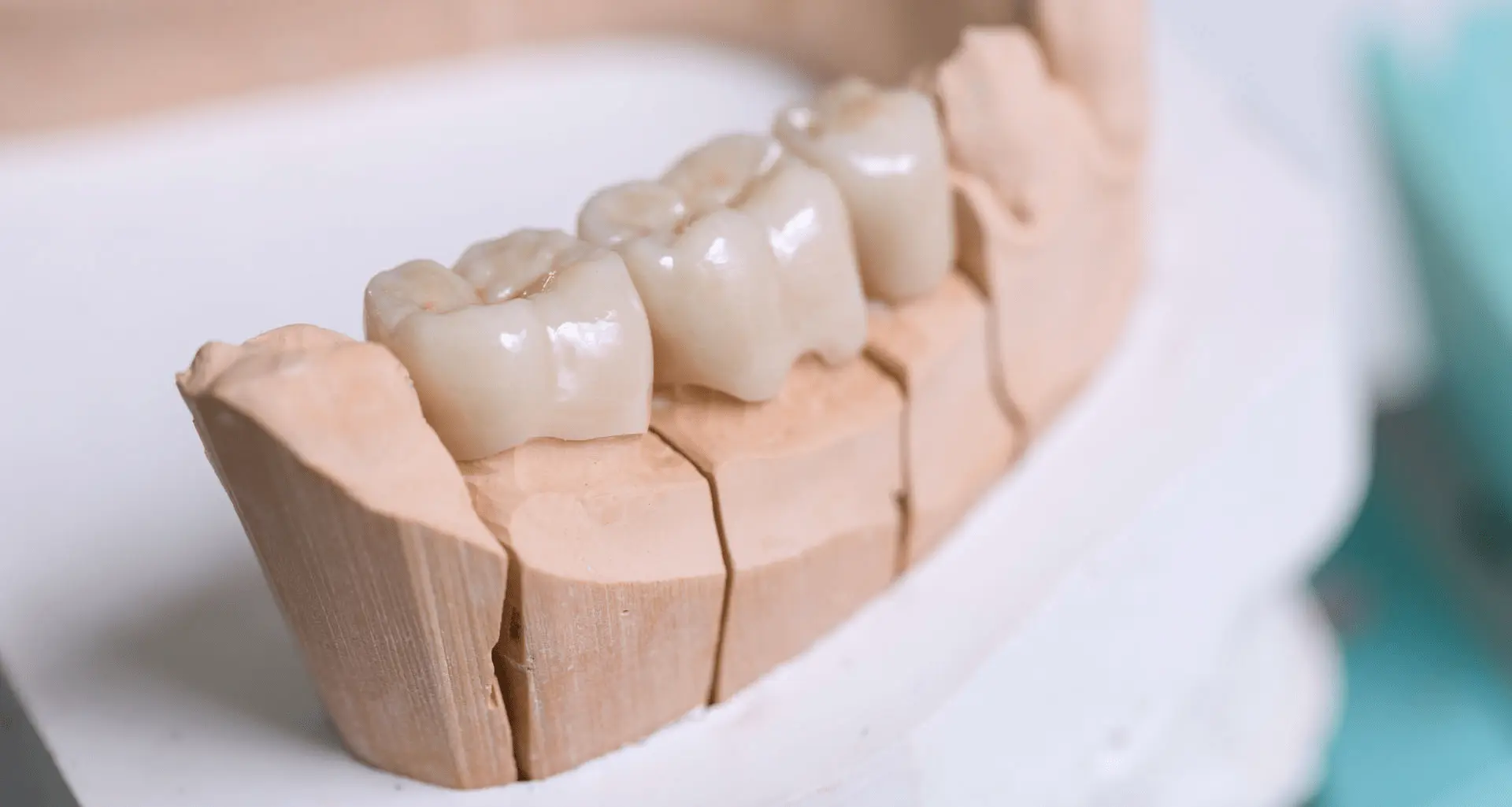 Zubne krunice u Hrvatskoj - Zubne krunice Zagreb | Štimac centar dentalne medicine