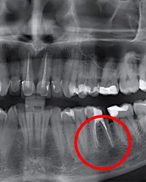 Apikotomija - kirurško odstranjenje vrška korijena - Apikotomija - kirurško odstranjenje vrška korijena | Štimac centar dentalne medicine
