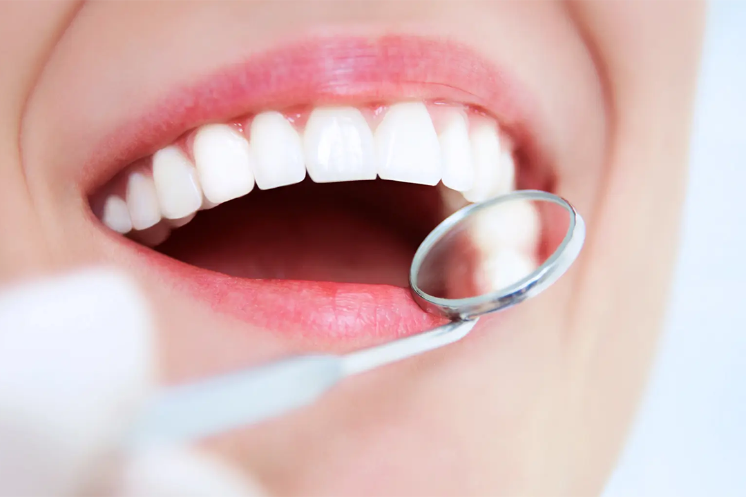 Čišćenje zubnog kamenca - Čišćenje zubnog kamenca | Štimac centar dentalne medicine