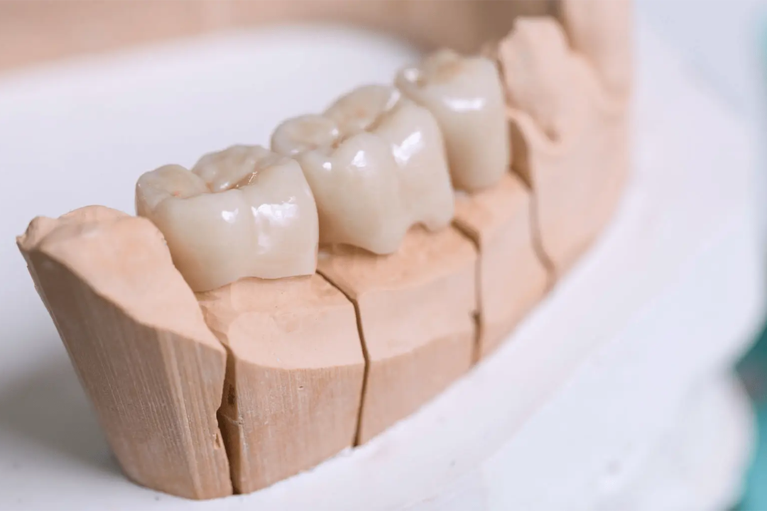 Zubne krunice u Hrvatskoj - Zubne krunice Zagreb | Štimac centar dentalne medicine