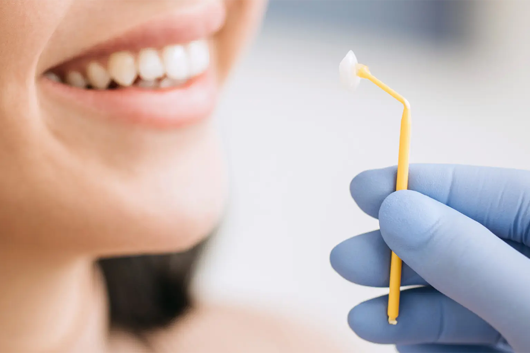 Ljuskice za zube - Ljuskice za zube | Štimac centar dentalne medicine