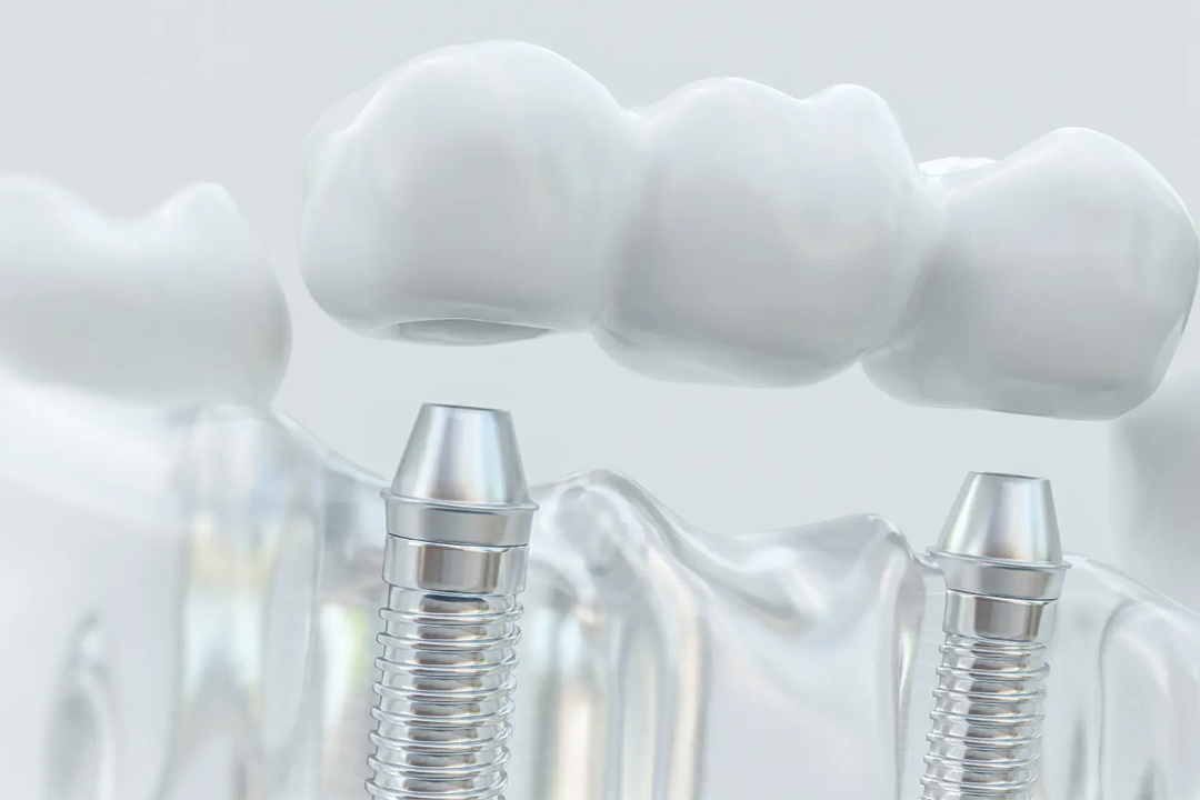 Zubni implantati - Zubni implantati | Štimac centar dentalne medicine