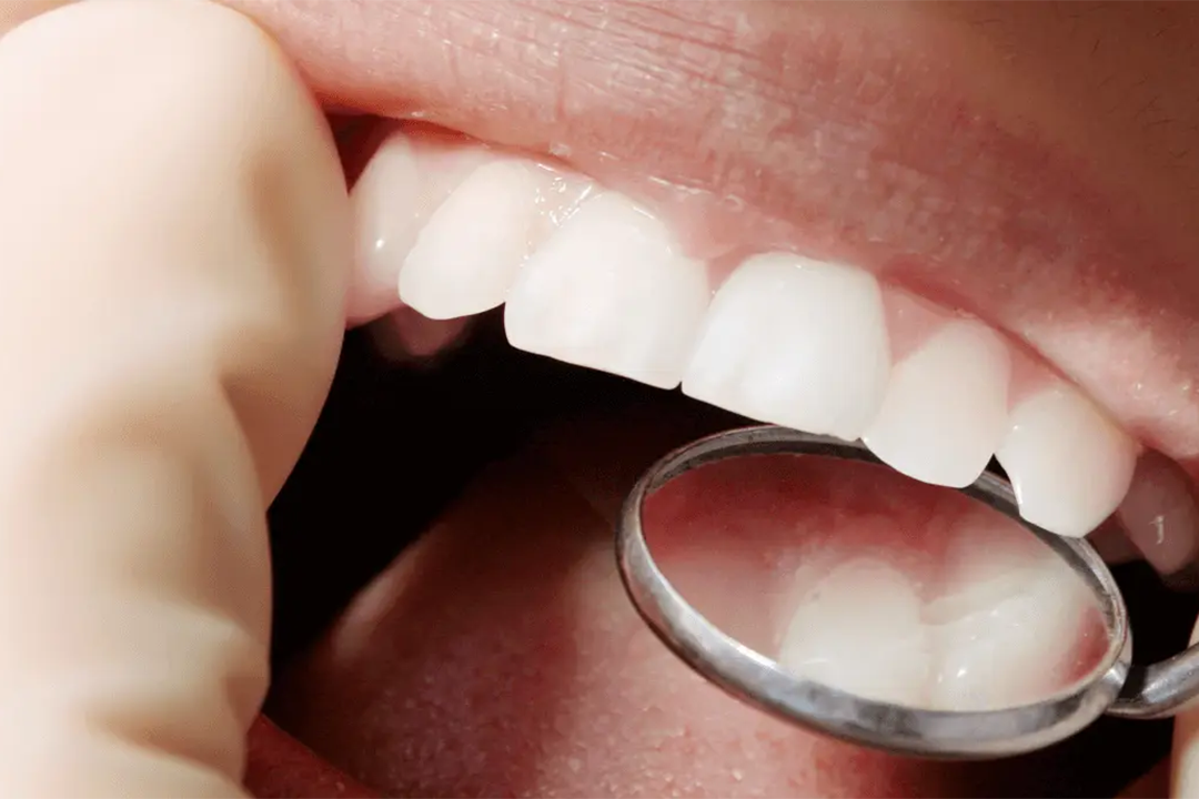 Ispuni - Ispuni | Štimac centar dentalne medicine