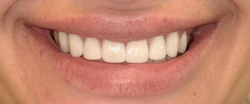 O nama - Prije i poslije | Štimac Centar dentalne medicine | Studije slučaja novo | Štimac Centar dentalne medicine | Studije slučaja