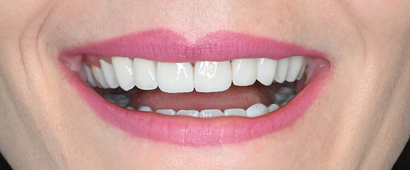 O nama - Prije i poslije | Štimac Centar dentalne medicine | Studije slučaja novo | Štimac Centar dentalne medicine | Studije slučaja