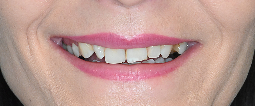 O nama - Prije i poslije | Štimac Centar dentalne medicine | Studije slučaja novo | Štimac Centar dentalne medicine | Studije slučaja