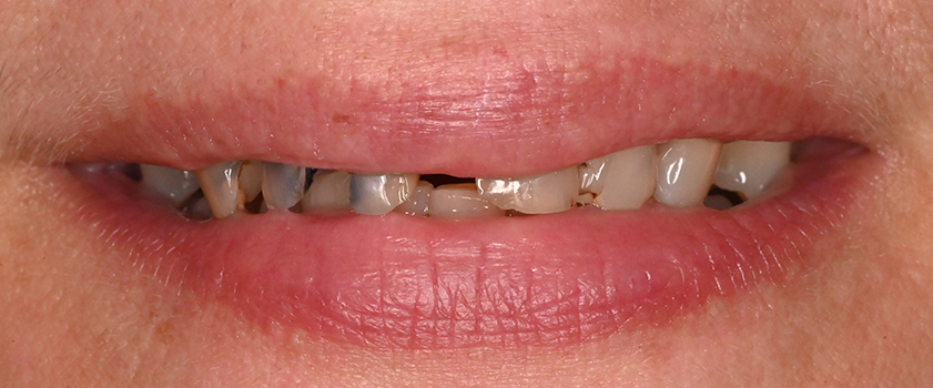 O nama - Prije i poslije | Štimac Centar dentalne medicine | Studije slučaja novo | Štimac Centar dentalne medicine | Studije slučaja