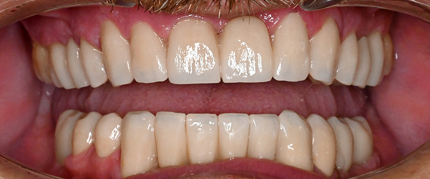 O nama - Prije i poslije | Štimac Centar dentalne medicine | Studije slučaja novo | Štimac Centar dentalne medicine | Studije slučaja