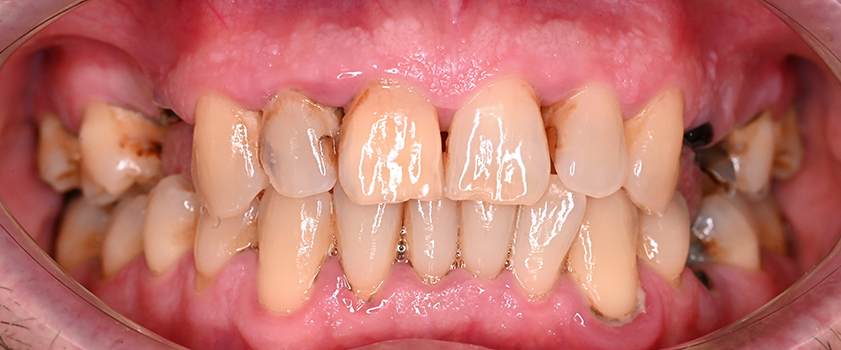 O nama - Prije i poslije | Štimac Centar dentalne medicine | Studije slučaja novo | Štimac Centar dentalne medicine | Studije slučaja