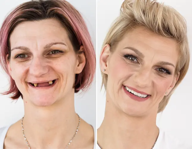 Zubni implantati | Ugradnja i Cijena | Štimac Centar dentalne medicine | Zubni implantati | Rezultati implantati #2