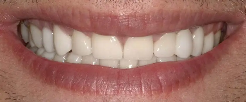 O nama - Prije i poslije | Štimac Centar dentalne medicine | Studije slučaja | Slučaj ugradnje ljuskica i krunica