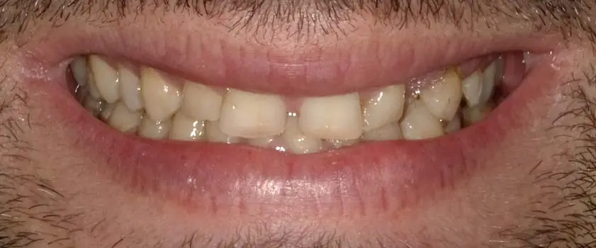 O nama - Prije i poslije | Štimac Centar dentalne medicine | Studije slučaja | Slučaj ugradnje ljuskica i krunica