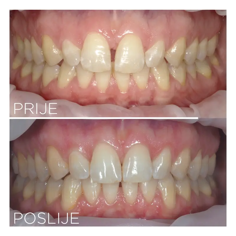 Ortodontska terapija alignerima | Štimac centar dentalne medicine | Ortodontska terapija | Stomatološka poliklinika Zagreb | Štimac centar dentalne medicine