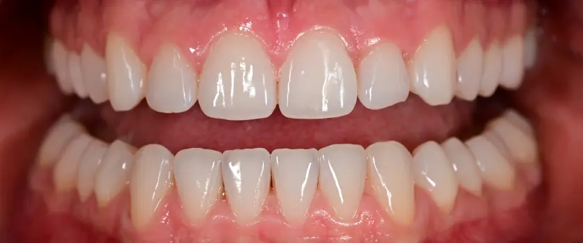 O nama - Prije i poslije | Štimac Centar dentalne medicine | Studije slučaja | IMPLANTATI