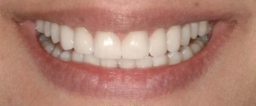 O nama - Prije i poslije | Štimac Centar dentalne medicine | Studije slučaja | Slučaj ugradnje ljuskica i krunica