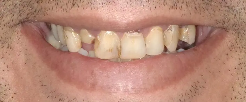 O nama - Prije i poslije | Štimac Centar dentalne medicine | Studije slučaja | Slučaj ugradnje implantata, mostova i krunica
