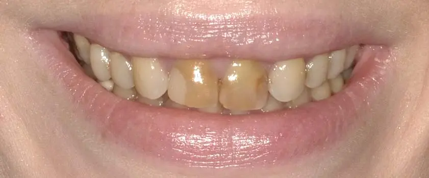 O nama - Prije i poslije | Štimac Centar dentalne medicine | Studije slučaja | Slučaj ugradnje ljuskica i krunica