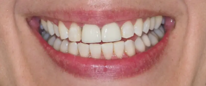 O nama - Prije i poslije | Štimac Centar dentalne medicine | Studije slučaja | IMPLANTATI