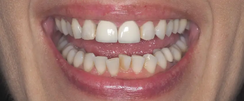 O nama - Prije i poslije | Štimac Centar dentalne medicine | Studije slučaja | IMPLANTATI
