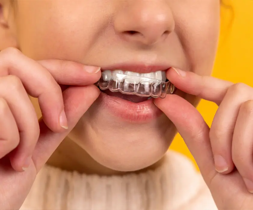 Ortodontska terapija alignerima | Štimac centar dentalne medicine | Ortodontska terapija | Stomatološka poliklinika Zagreb | Štimac centar dentalne medicine