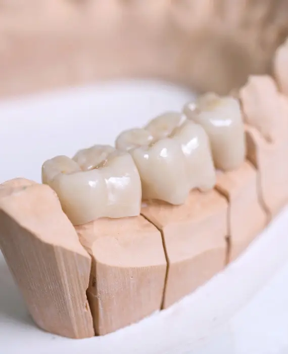 Zubna proteza | Zubna protetika | Štimac Centar dentalne medicine | Zubna protetika | Stomatološka poliklinika Zagreb | Štimac centar dentalne medicine