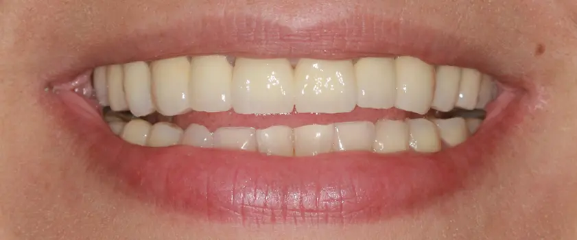 O nama - Prije i poslije | Štimac Centar dentalne medicine | Studije slučaja | ZUBNE KRUNICE