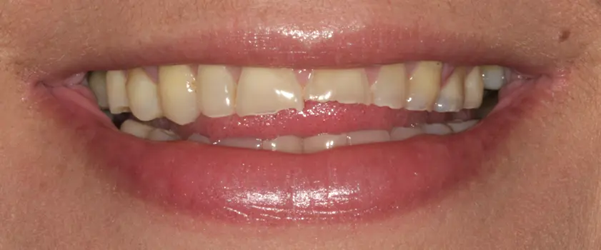 O nama - Prije i poslije | Štimac Centar dentalne medicine | Studije slučaja | ZUBNE KRUNICE