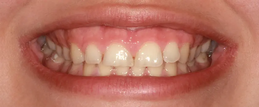 O nama - Prije i poslije | Štimac Centar dentalne medicine | Studije slučaja | PORCULANSKE LJUSKICE ZA ZUBE