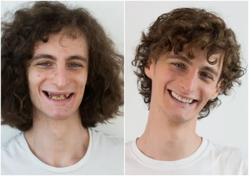 Zubne krunice u Hrvatskoj | Dentalni makeover | Štimac centar dentalne medicine