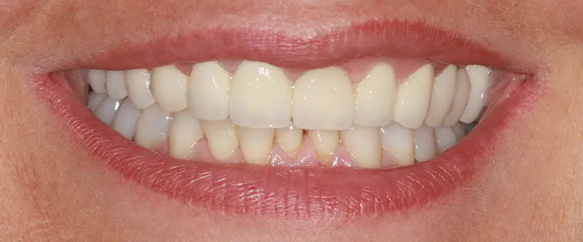 O nama - Prije i poslije | Štimac Centar dentalne medicine | Studije slučaja | ZUBNI MOSTOVI