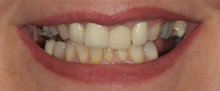 O nama - Prije i poslije | Štimac Centar dentalne medicine | Studije slučaja | ZUBNI MOSTOVI